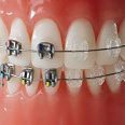 self-ligating-braces Orthodontic Braces treatments Delhi India