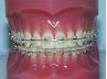 Colored Dental Braces in Delhi Orthodontic Braces treatments Delhi India