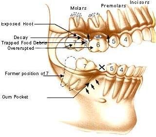 tooth-replacement-delhi-dental Replace Missing Tooth Delhi India