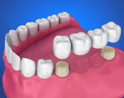 Dental Crown & Bridges