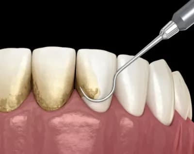 Gum Disease Treatment