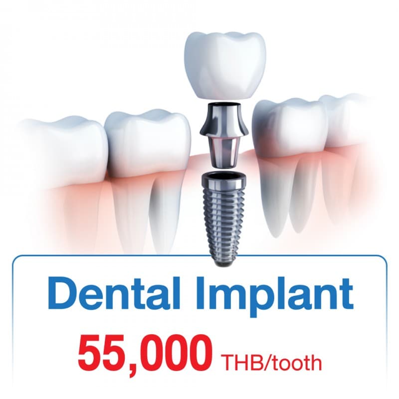 Dental Implant
