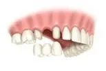 Dental Bridge