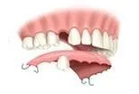 Removable Partial Dentures