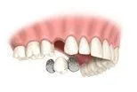 Maryland Dental Plate