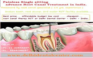 Price Of Root Canal Treatment Rct In East Delhi India Delhi Dental Center Dental Implants Braces And Tooth Whitening In Delhi India