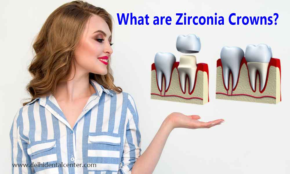 How Long Should A Zirconia All Ceramic Full Porcelain Crown Last