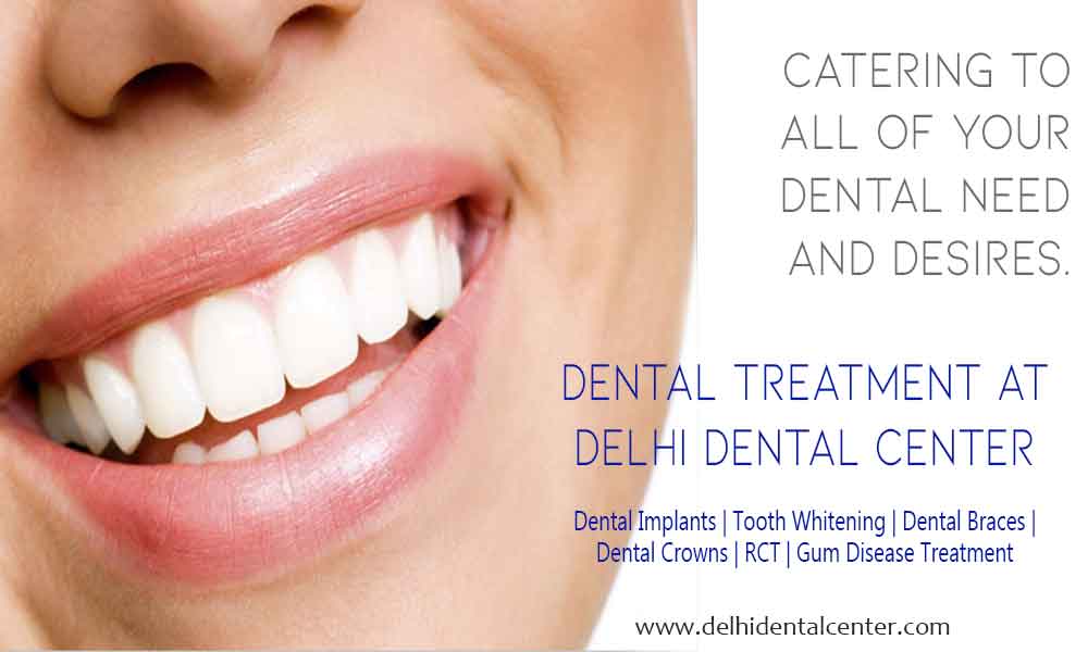 Tooth Whitening in Preet Vihar Delhi Dental Center